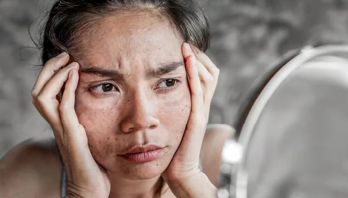 How Stress Is Hurting Your Skin